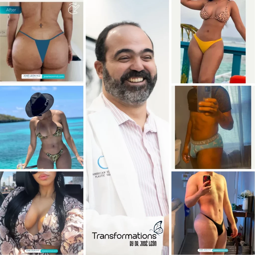 Patient Testimonials and Reviews, Transformations by Dr. José León MD | board certified plastic surgeon, Santo Domingo