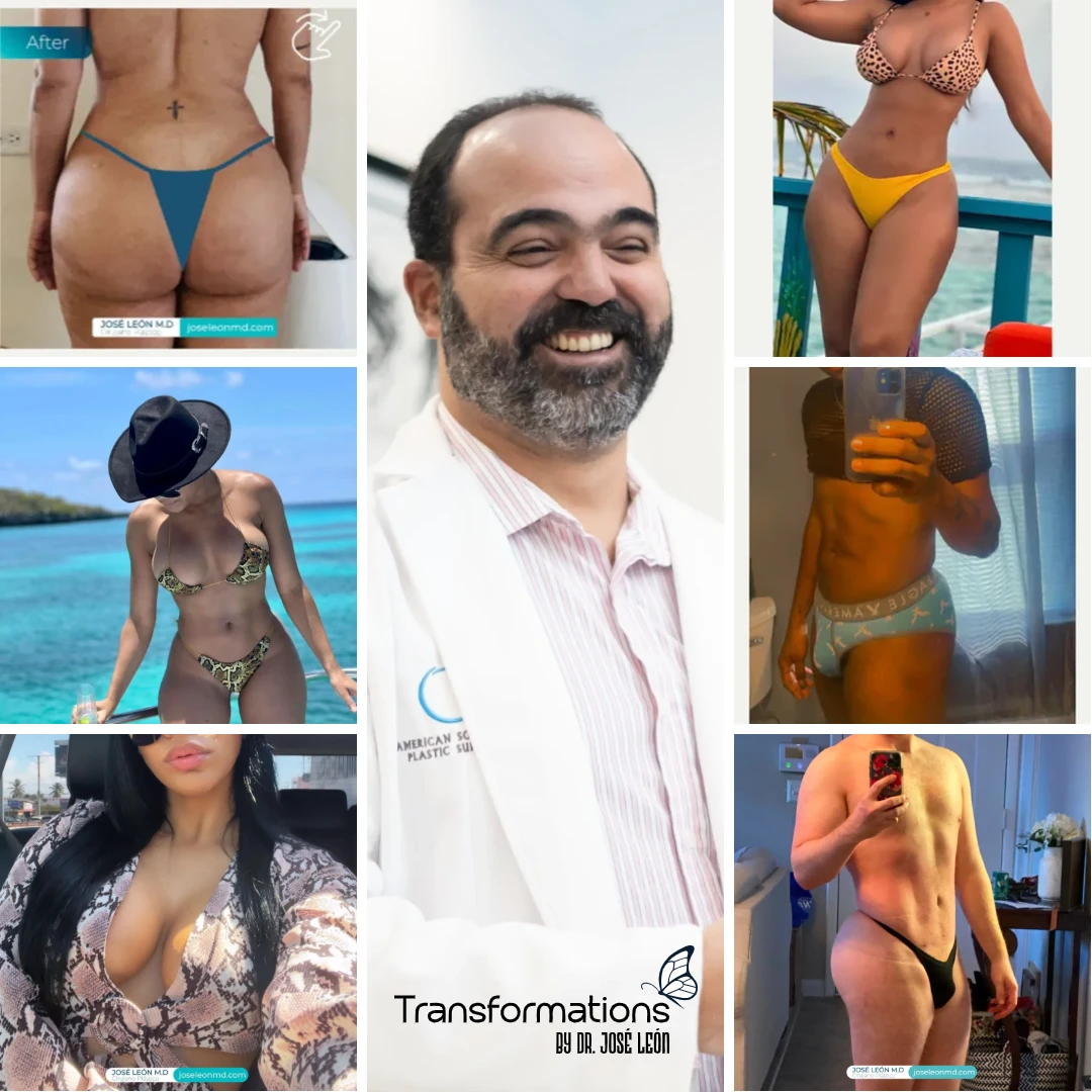 Patient Testimonials and Reviews, Transformations by Dr. José León MD | board certified plastic surgeon, Santo Domingo