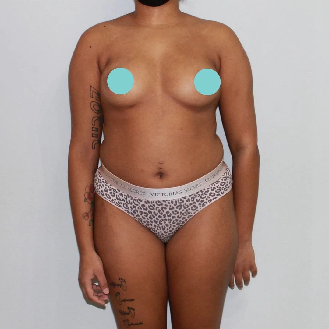 dr-jose-leon-md-patient-photos-3456-before.webp