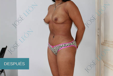 liposuction-after.jpg