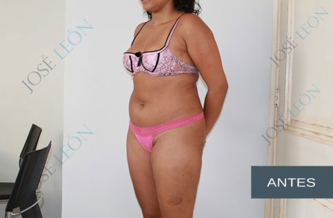 liposuction-before.jpg