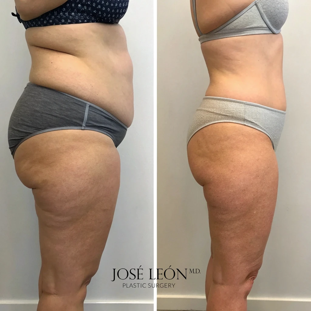 Intelligent RF lipolifting in Santo Domingo, for a better liposuction procedure — Dr. José León, MD, lipo filling, fat grafting
