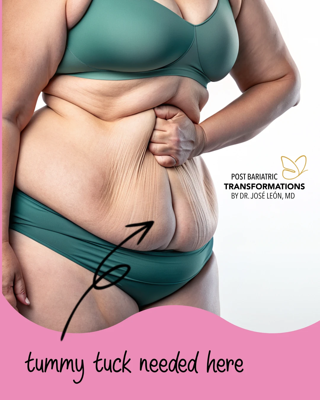 Abdominal Changes After Massive Weight Loss - Post Bariatric Transformations by Dr. José León, MD - Board Certified Plastic Surgeon, Santo Domingo, Dominican Republic