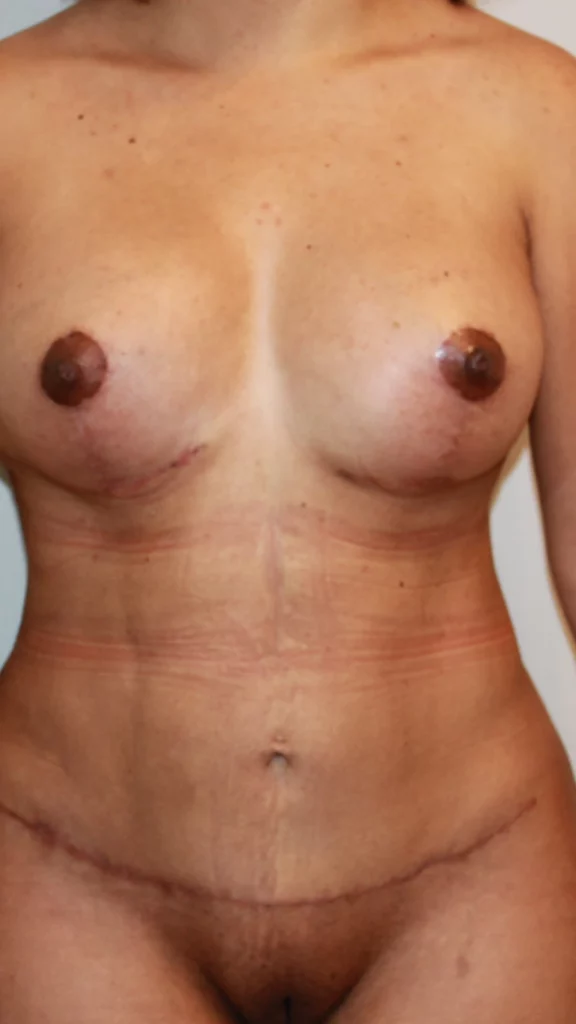 After, Mommy Makeover procedure by Dr. José León, MD - Board Certified Plastic Surgeon, Santo Domingo, Dominican Republic