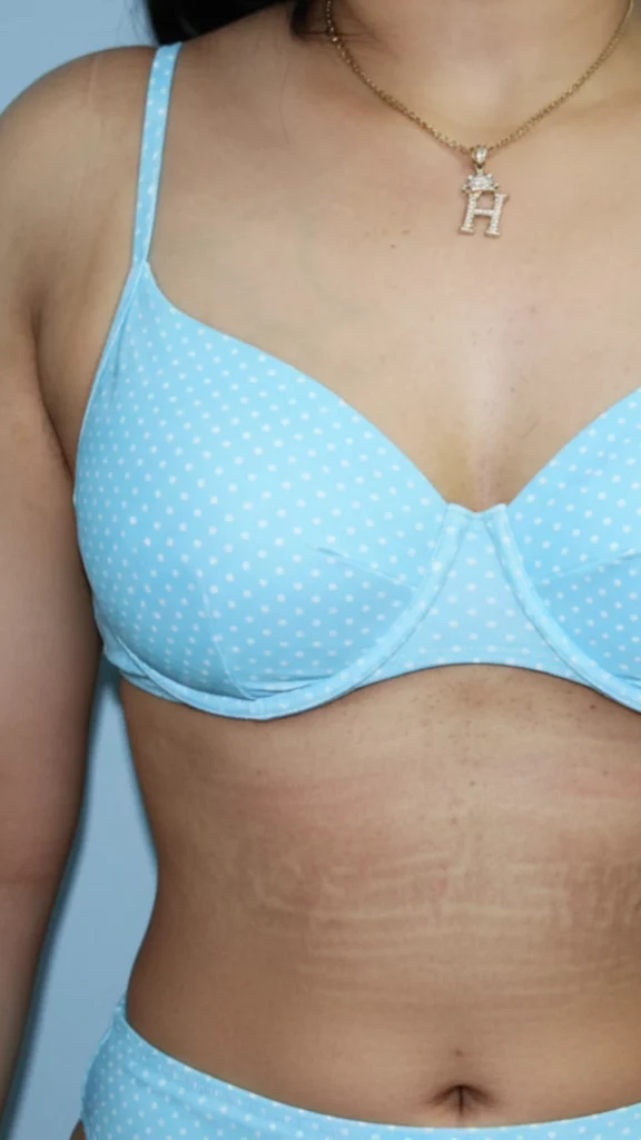 After, Mommy Makeover procedure by Dr. José León, MD - Board Certified Plastic Surgeon, Santo Domingo, Dominican Republic