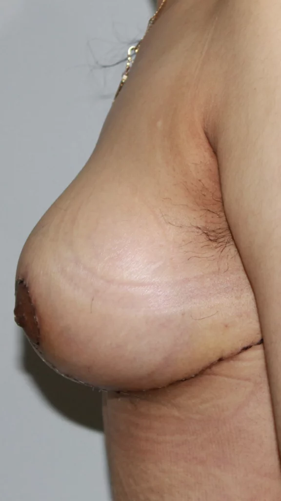 Before, Mommy Makeover procedure by Dr. José León, MD - Board Certified Plastic Surgeon, Santo Domingo, Dominican Republic