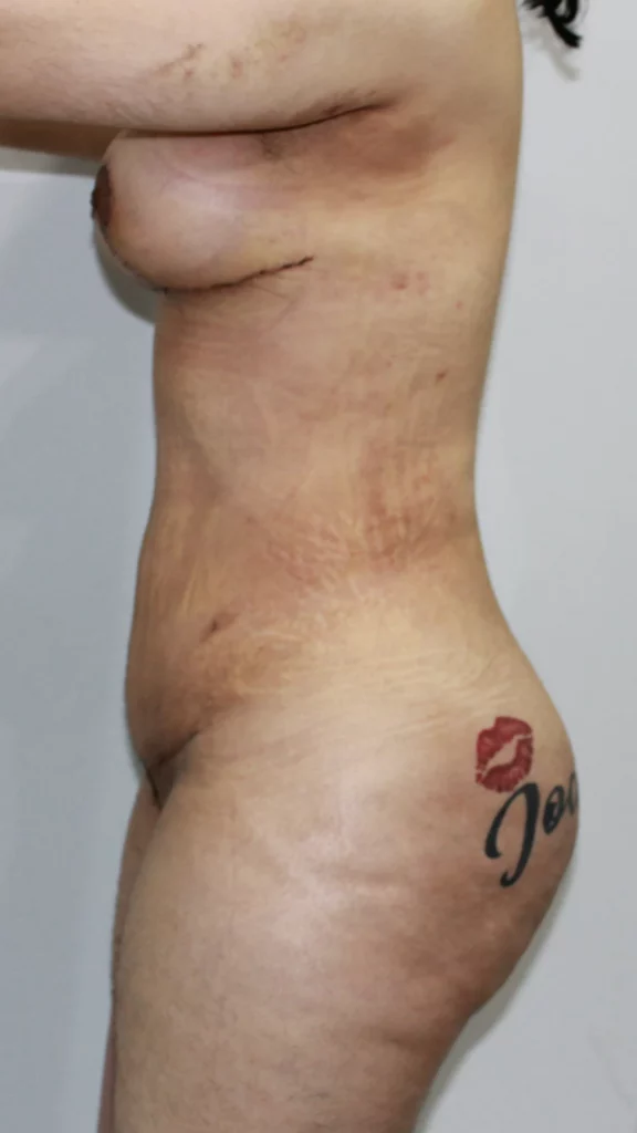 Before, Mommy Makeover procedure by Dr. José León, MD - Board Certified Plastic Surgeon, Santo Domingo, Dominican Republic