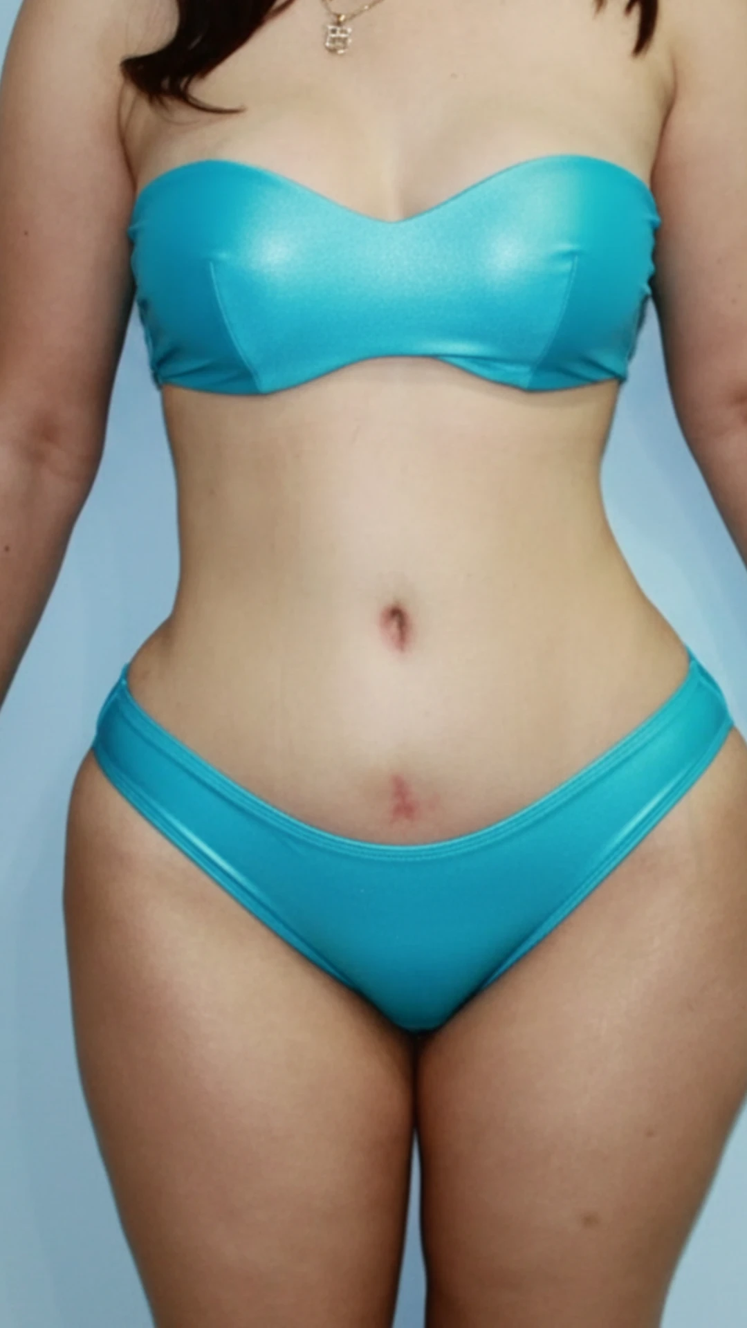 After, Mommy Makeover procedure by Dr. José León, MD - Board Certified Plastic Surgeon, Santo Domingo, Dominican Republic