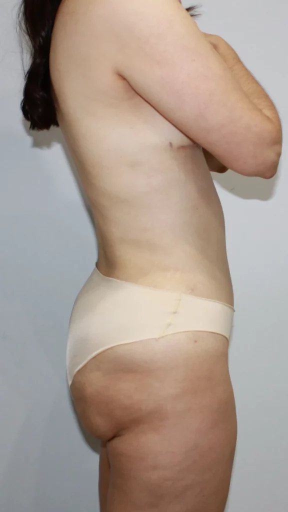 After, Mommy Makeover procedure by Dr. José León, MD - Board Certified Plastic Surgeon, Santo Domingo, Dominican Republic