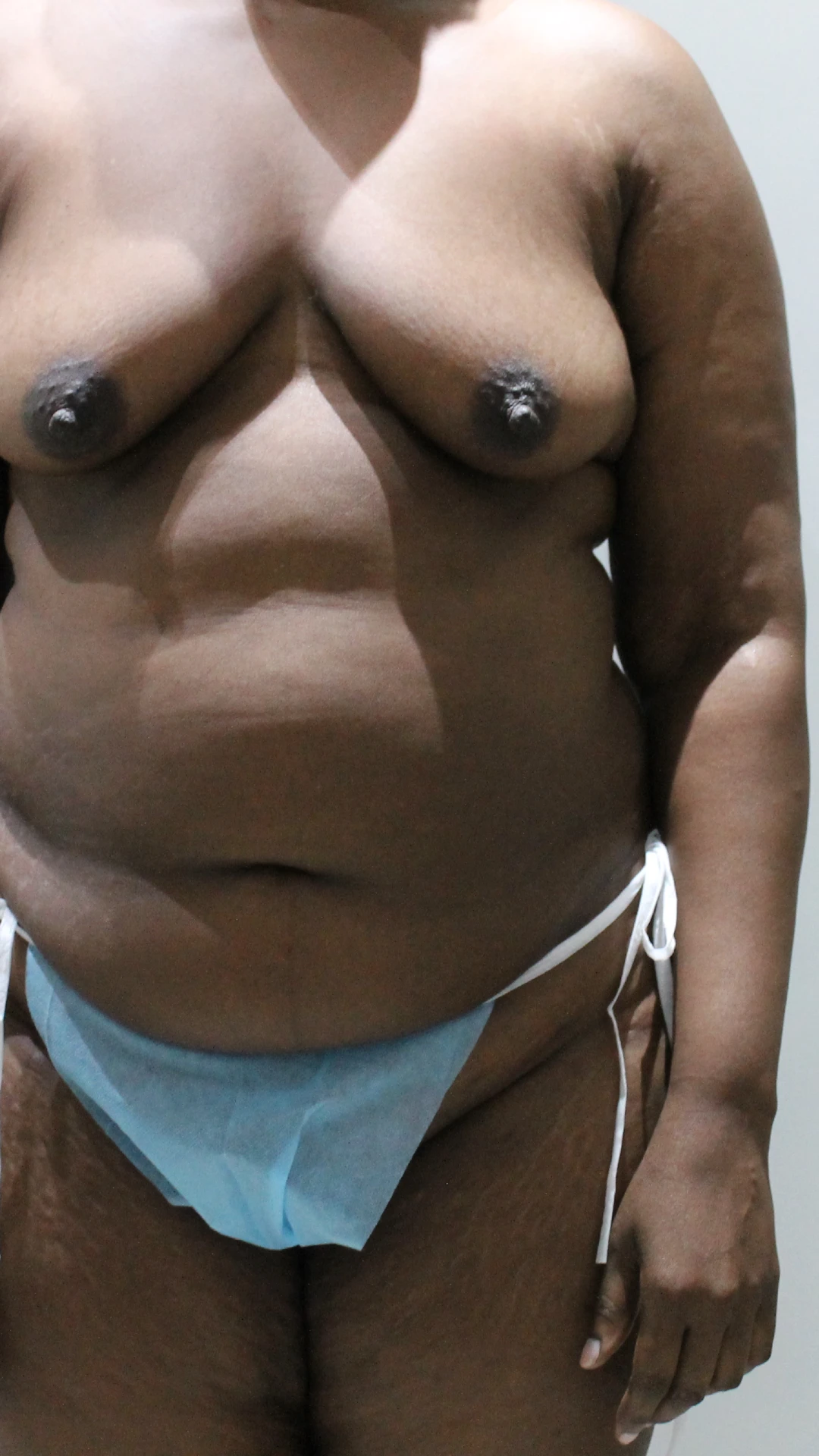 Before, Mommy Makeover procedure by Dr. José León, MD - Board Certified Plastic Surgeon, Santo Domingo, Dominican Republic