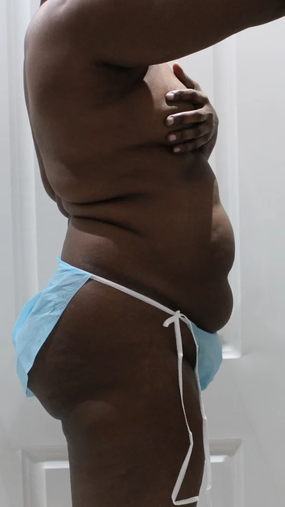 Before, Mommy Makeover procedure by Dr. José León, MD - Board Certified Plastic Surgeon, Santo Domingo, Dominican Republic