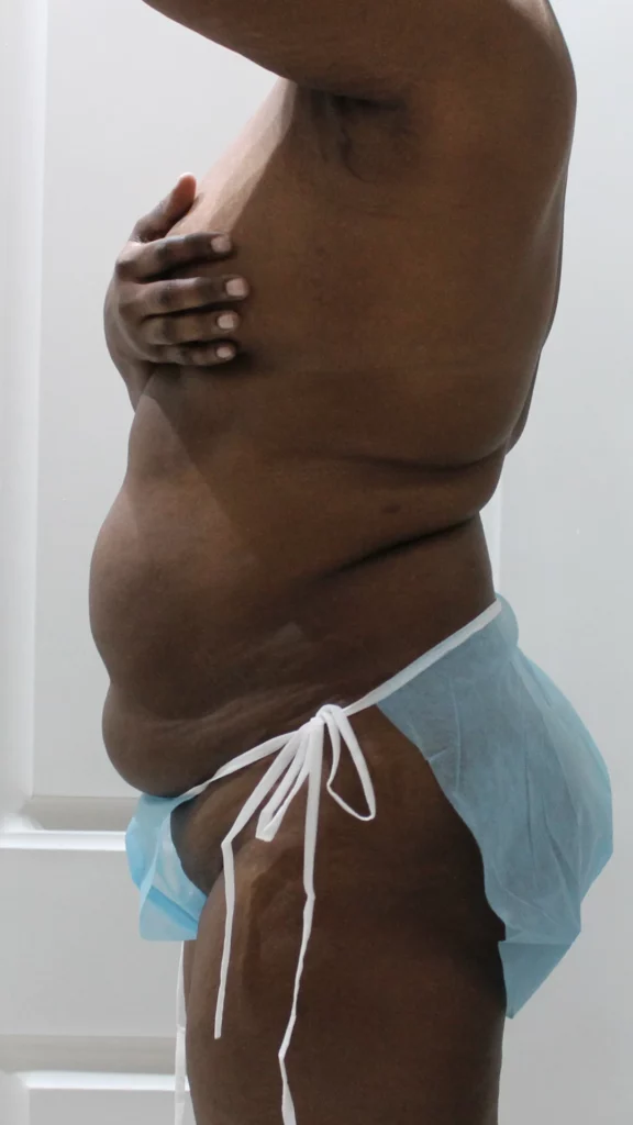 Before, Mommy Makeover procedure by Dr. José León, MD - Board Certified Plastic Surgeon, Santo Domingo, Dominican Republic