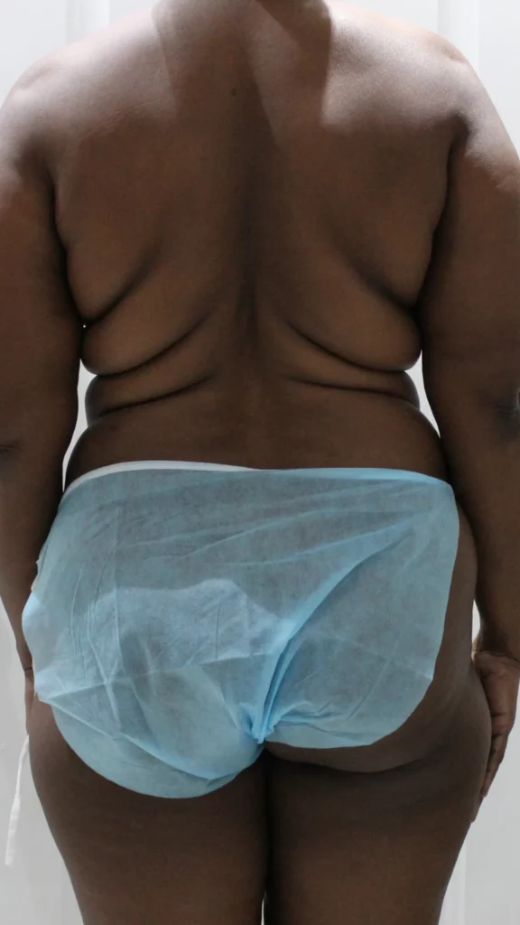 Before, Mommy Makeover procedure by Dr. José León, MD - Board Certified Plastic Surgeon, Santo Domingo, Dominican Republic