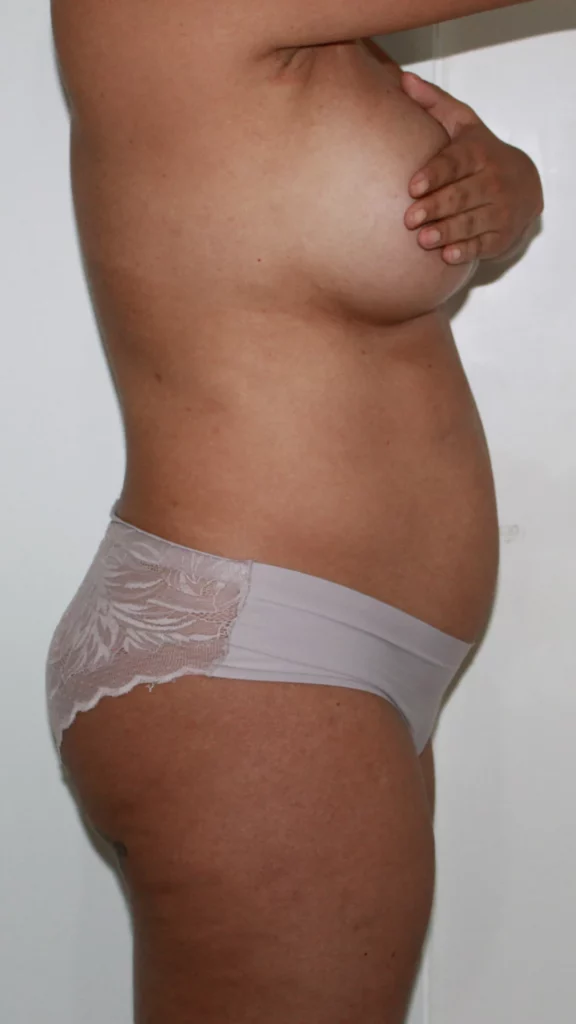 Before, Mommy Makeover procedure by Dr. José León, MD - Board Certified Plastic Surgeon, Santo Domingo, Dominican Republic