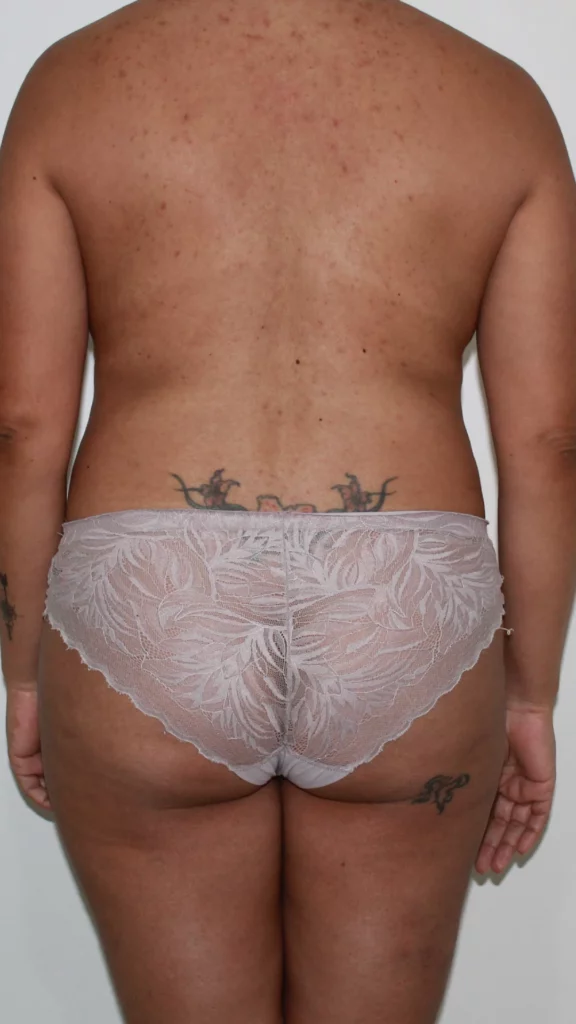 Before, Mommy Makeover procedure by Dr. José León, MD - Board Certified Plastic Surgeon, Santo Domingo, Dominican Republic