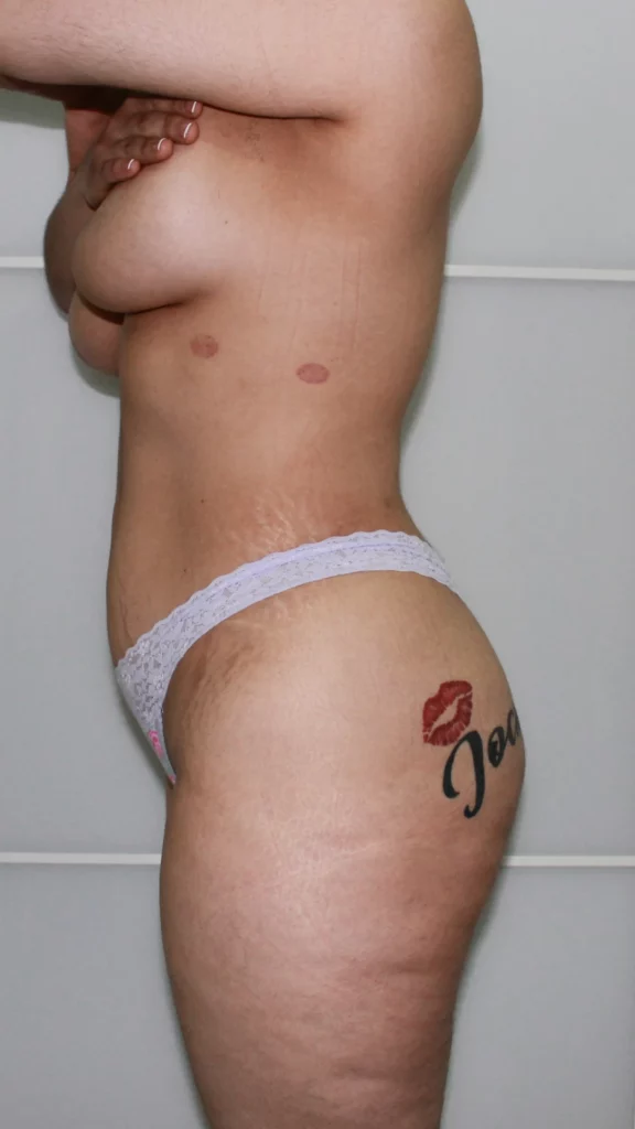 Before, Mommy Makeover procedure by Dr. José León, MD - Board Certified Plastic Surgeon, Santo Domingo, Dominican Republic