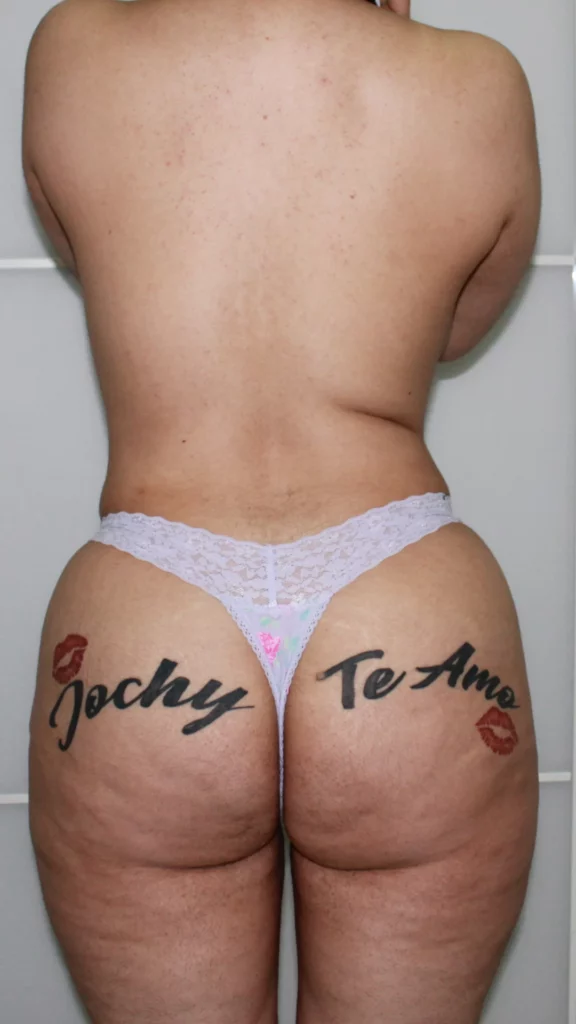 Before, Mommy Makeover procedure by Dr. José León, MD - Board Certified Plastic Surgeon, Santo Domingo, Dominican Republic