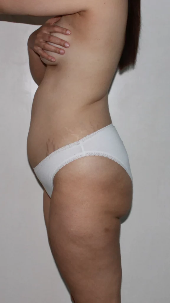 Before, Mommy Makeover procedure by Dr. José León, MD - Board Certified Plastic Surgeon, Santo Domingo, Dominican Republic