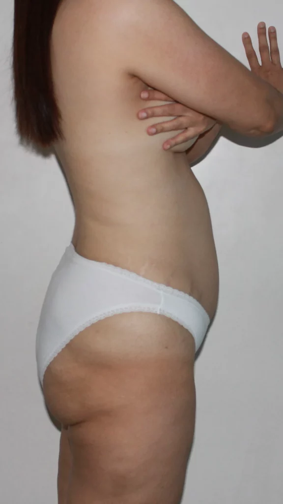 Before, Mommy Makeover procedure by Dr. José León, MD - Board Certified Plastic Surgeon, Santo Domingo, Dominican Republic