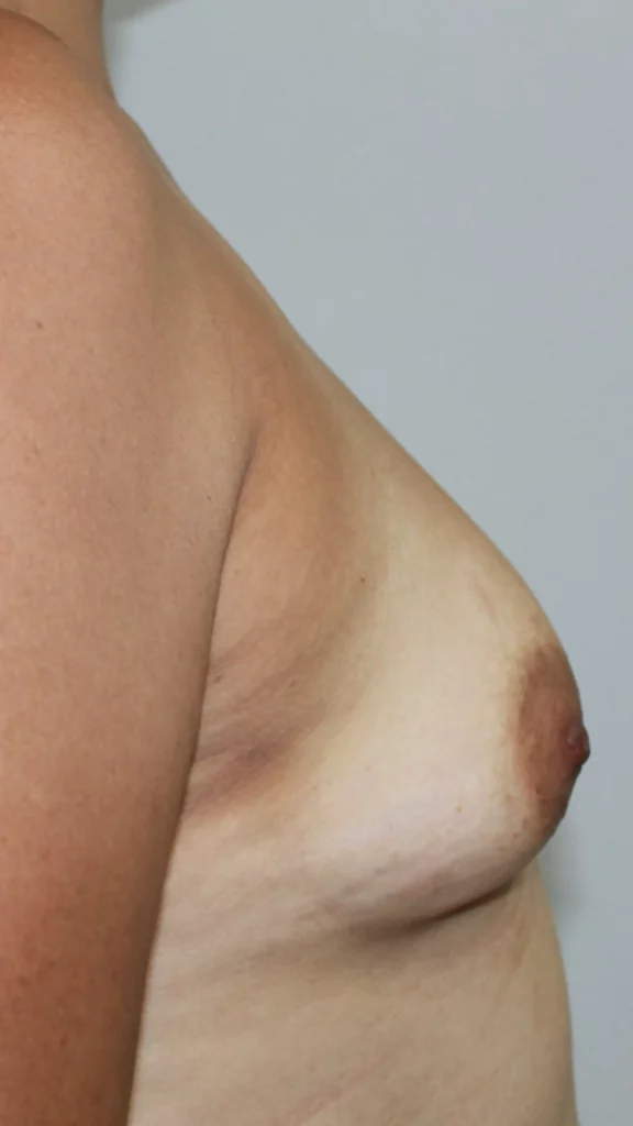 Before, Mommy Makeover procedure by Dr. José León, MD - Board Certified Plastic Surgeon, Santo Domingo, Dominican Republic