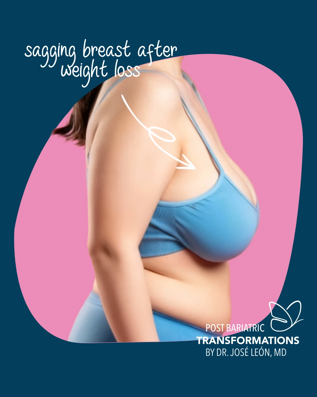 Breast Changes After Massive Weight Loss - Post Bariatric Transformations by Dr. José León, MD - Board Certified Plastic Surgeon, Santo Domingo, Dominican Republic