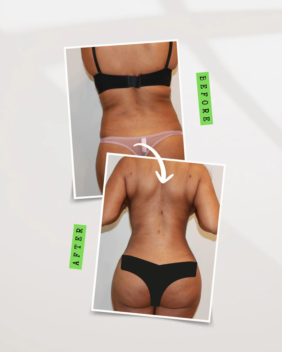 Liposuction and Tummy Tuck by Dr. José León, MD - Board Certified Plastic Surgeon, Santo Domingo, Dominican Republic