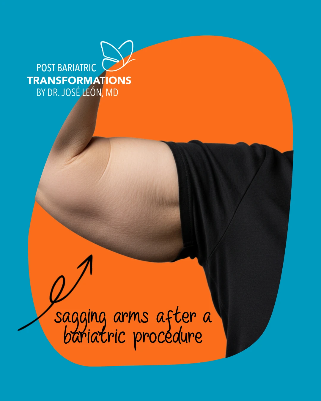 Sagging Arms After Weight Loss - Post Bariatric Transformations by Dr. José León, MD - Board Certified Plastic Surgeon, Santo Domingo, Dominican Republic