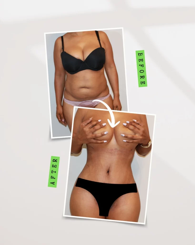Tummy Tuck and Liposuction by Dr. José León, MD - Board Certified Plastic Surgeon, Santo Domingo, Dominican Republic