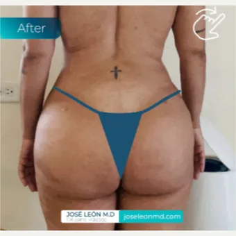 Brazilian butt lift, bbl by Dr. José León, MD - Certified Plastic Surgeon, before