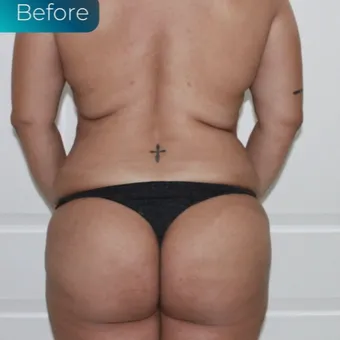 Brazilian butt lift, bbl by Dr. José León, MD - Certified Plastic Surgeon, after