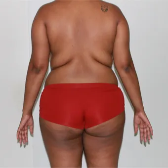 Brazilian butt lift, bbl by Dr. José León, MD - Certified Plastic Surgeon, before