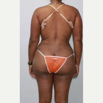 Brazilian butt lift, bbl by Dr. José León, MD - Certified Plastic Surgeon, after