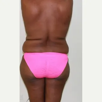 Brazilian butt lift, bbl by Dr. José León, MD - Certified Plastic Surgeon, before