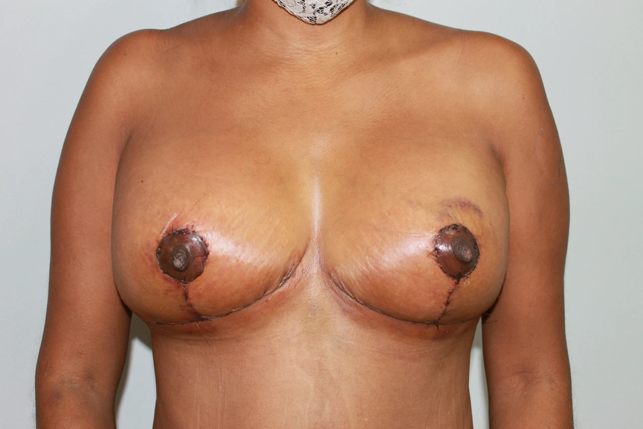 Breast lift with no implants, after | Dr. José León MD, plastic surgeon, Santo Domingo