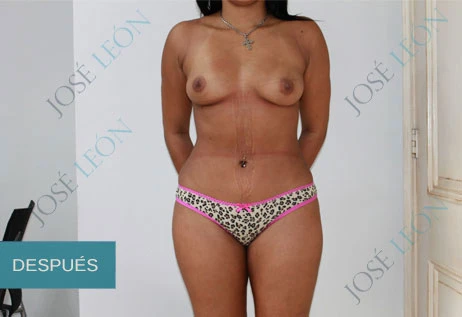 VASER liposuction, after, 36-years old | Dr. José León MD, plastic surgeon, Santo Domingo