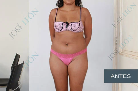 VASER liposuction, before, 36-years old | Dr. José León MD, plastic surgeon, Santo Domingo